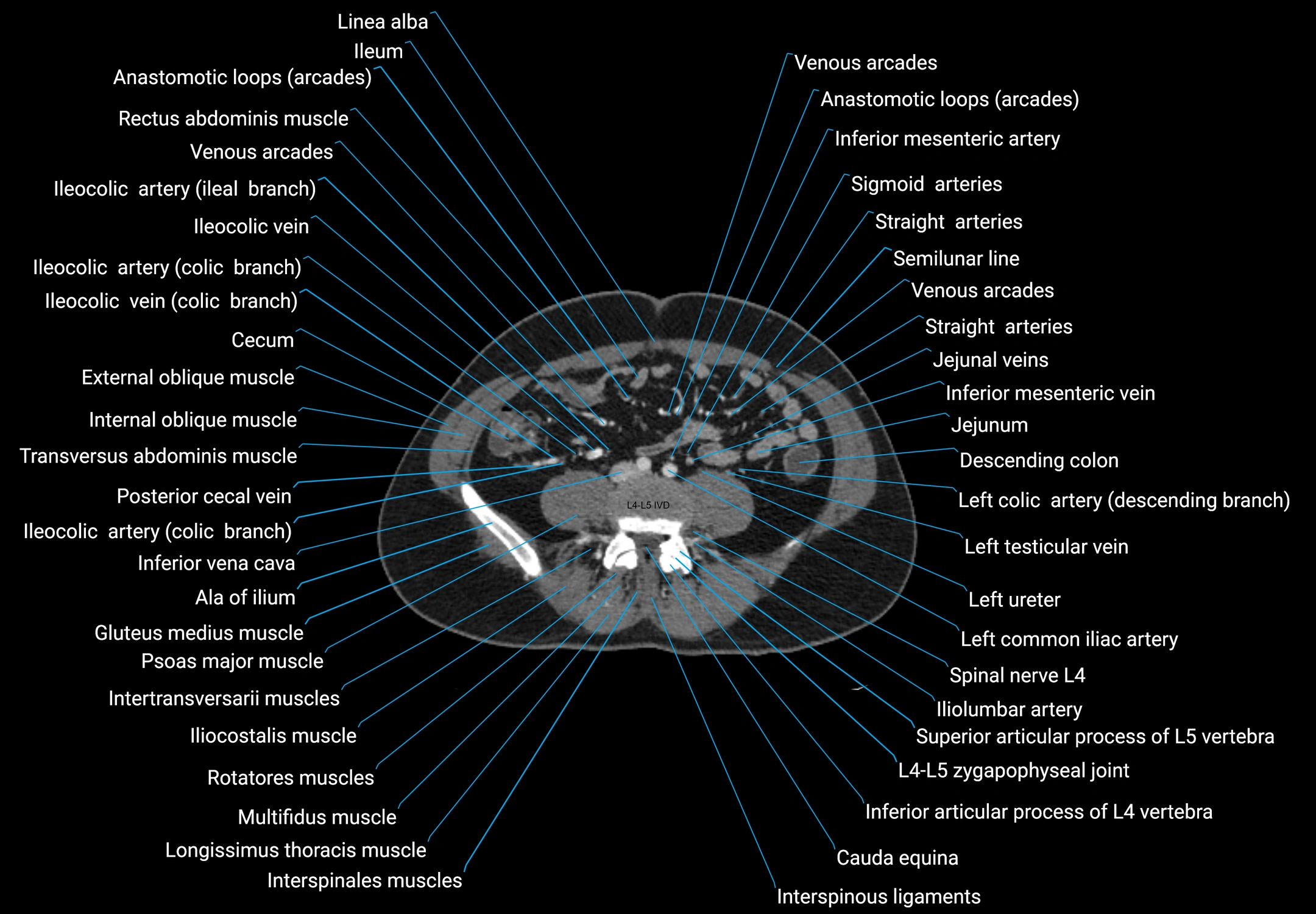 CT male pelvis axial cross sectional anatomy labelled radiology image -00119.webp